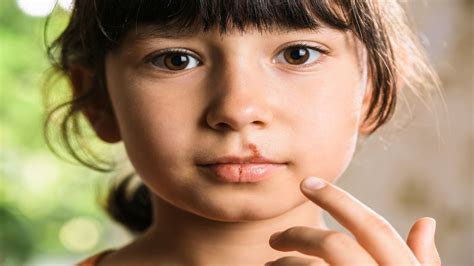 Cold Sores In Kids: What Parents Need To Know - A Nation of Moms
