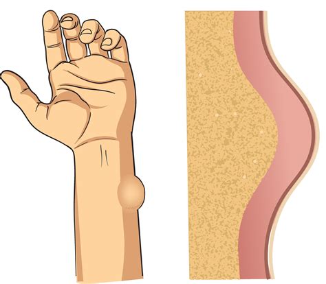lipoma illustration in hand 31744560 Vector Art at Vecteezy