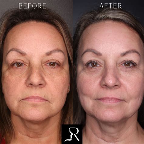 laser skin resurfacing results  houma la brian roberts md