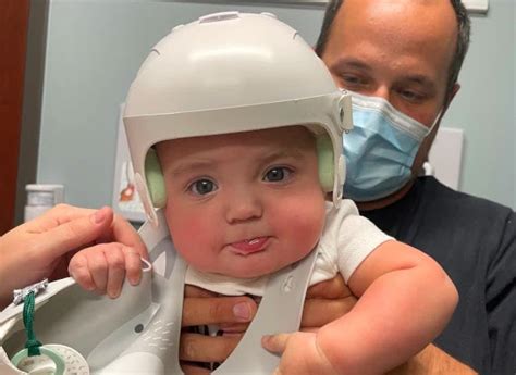 navigate  complexities  plagiocephaly treatment