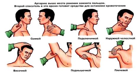 Первая помощь при кровотечениях - презентация онлайн