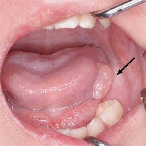 An elastic, soft, pedunculated nodule 12 mm in diameter was detected on ...