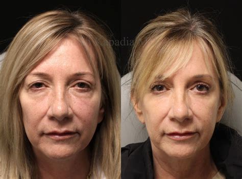 months   blepharoplasty surgery
