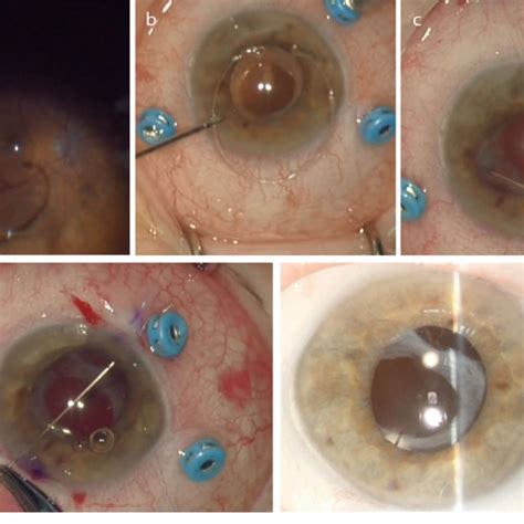 Surgical management of a toric IOL and CTR posterior dislocation. a A ...
