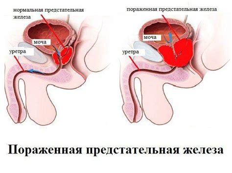 Обострение простатита: симптомы и лечение, причины, признаки, стадии