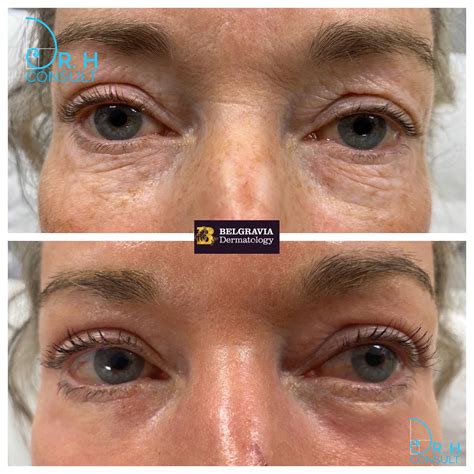 Laser Eyelid Lift