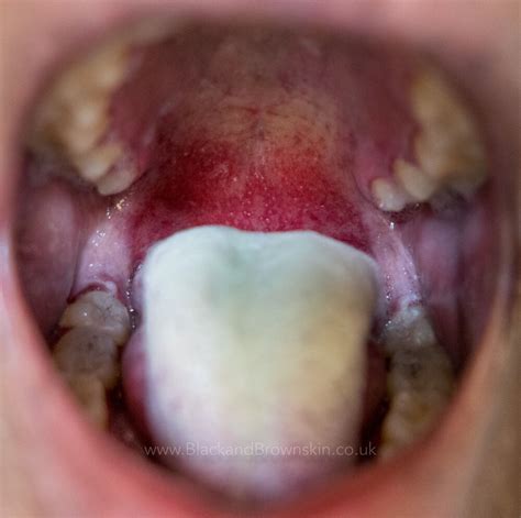 scarlet fever tongue
