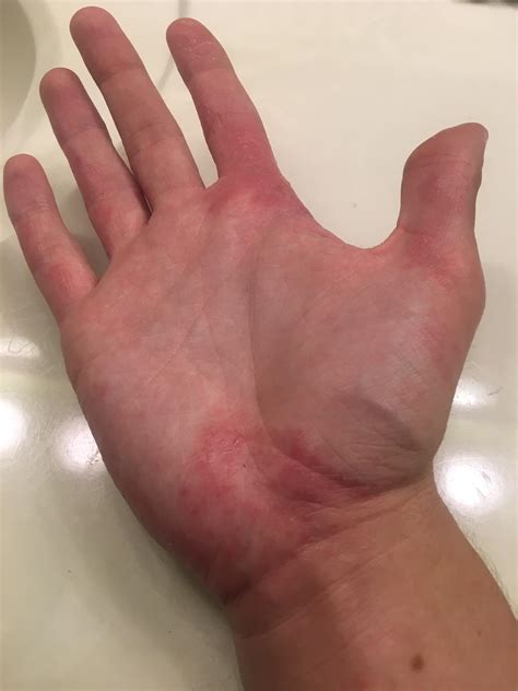 Mild Eczema Hands