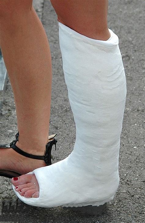 Leg cast SLWC plaster walking cast with toe plate gips yeso gesso | Leg