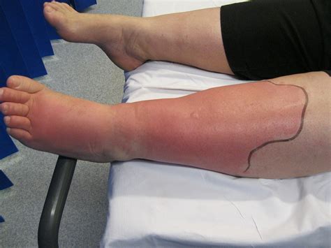 Cellulitis | Eron Classification | Antibiotics | Geeky Medics