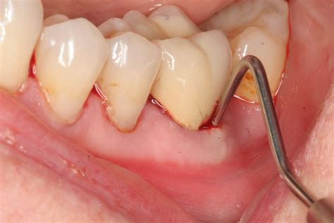 Tooth Abscess Drain