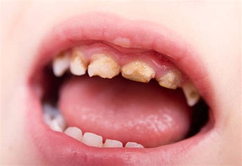 990+ Rotten Teeth In Children Stock Photos, Pictures & Royalty-Free ...