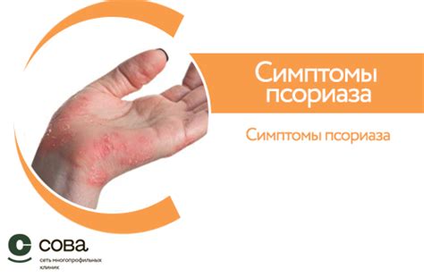 Псориаз: что это, причины, симптомы, первые признаки и лечение ...