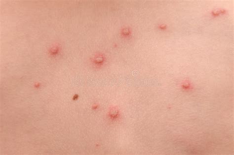 Chickenpox stock photo. Image of sick, pimples, itch - 12338740