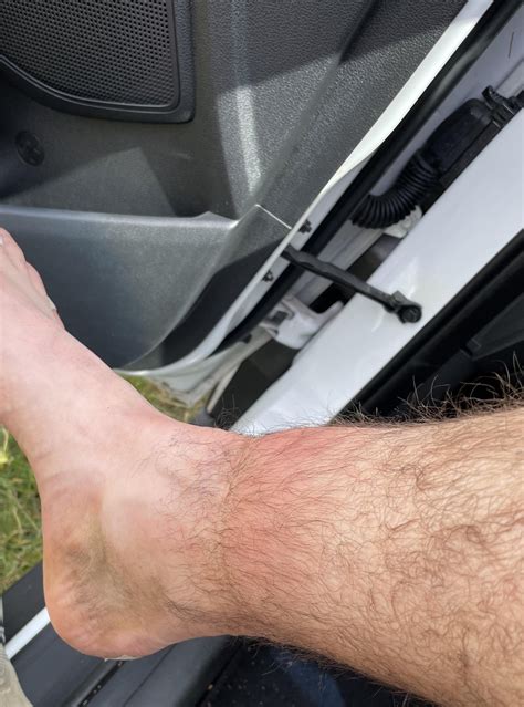 Tendon issues? : r/Ultramarathon