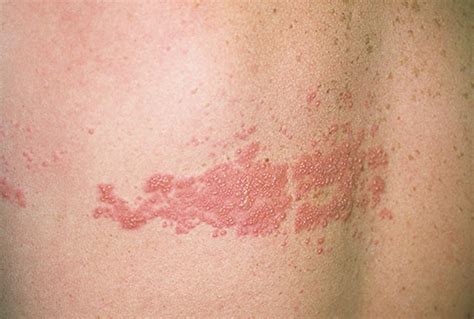 Identifying Skin Rashes Shingles