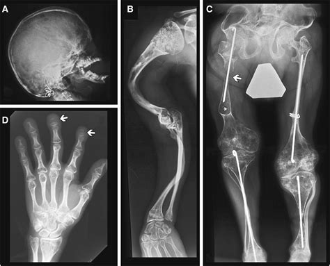 Cole-Carpenter Syndrome Is Caused by a Heterozygous Missense Mutation ...