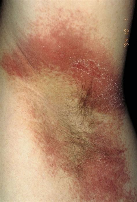 circular rashes  arent ringworm