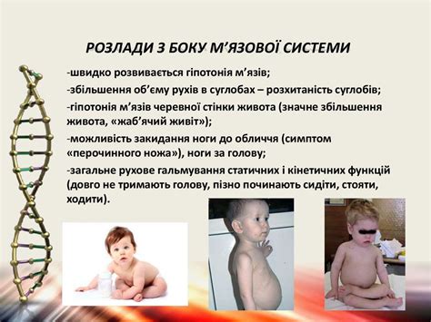 Гіповітаміноз. Рахіт. Гіпервітаміноз вітаміну Д. Гіпокальціємічний ...