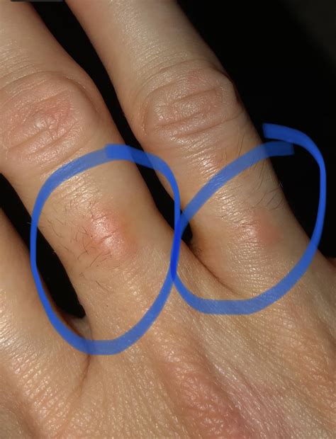 Not exactly a ring rash : r/DermatologyQuestions