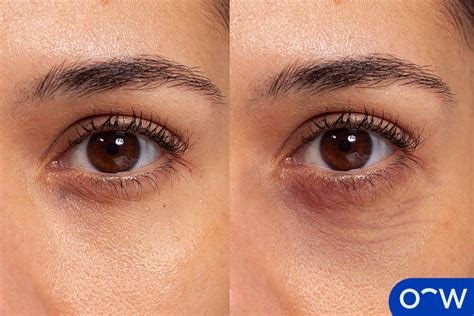 Puffy Eyes: Definition, Causes, Symptoms, and Treatment