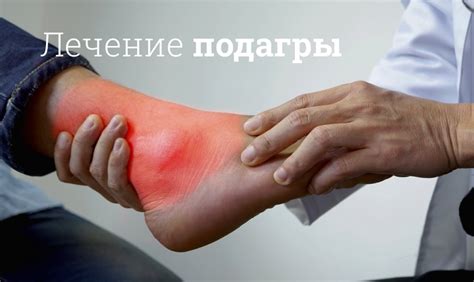 Что такое подагра у женщин симптомы фото