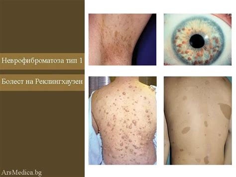 Висок креатинин – стойности, причини | ArsMedica.bg