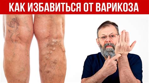 Варикоз. Как справиться? Причины. Как избежать? - YouTube