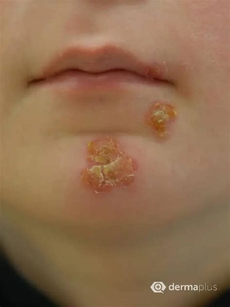 Borkenflechte (Impetigo contagiosa) - Ursachen & Therapie | derma.plus