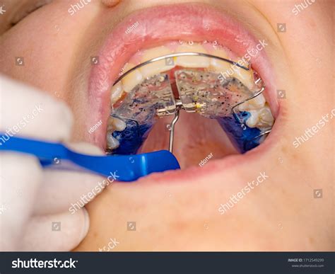 Doctor Setting Tool Hyrax Expander Rpe Stock Photo 1712549299 | Shutterstock