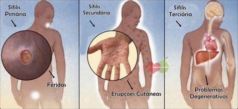 Sintomas E Tratamento Da Sifilis - Sífilis Causas, Sintomas e Tratamentos | Dicas de Saúde