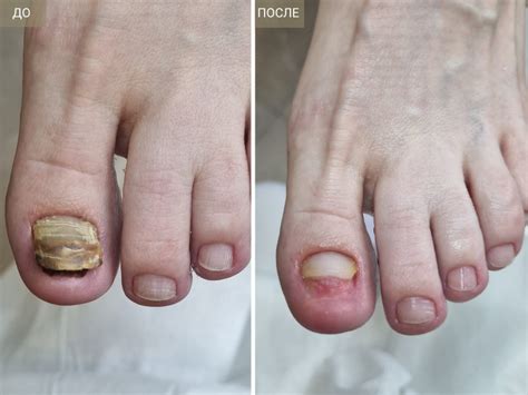 PACT-MED — цена фотодинамической терапии для лечения грибка ногтей в ...