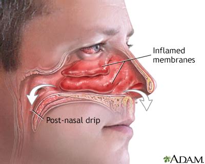 Stuffy or runny nose - adult Information | Mount Sinai - New York