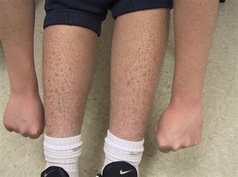 Ichthyosis: What Is Ichthyosis?