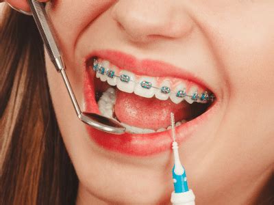 Teeth Cleaning Hacks For Braces Wearers: 11 Useful Tips