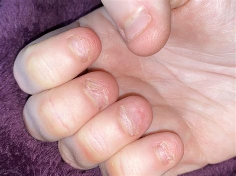 What Is The White Bits On Your Nails at Charles Erickson blog