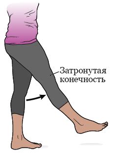 Информация об операции по пересадке лимфатического узла при лимфедеме ...