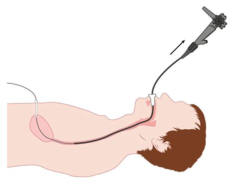 PEG-sonde endoscopische plaatsing (PID): H2 De PEG-sonde