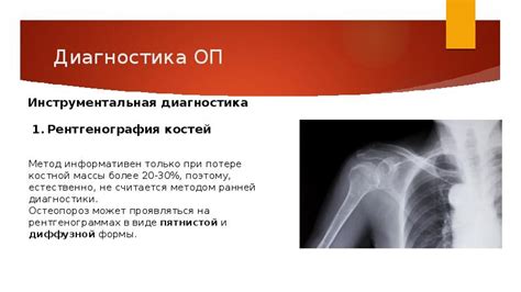 Остеопороз