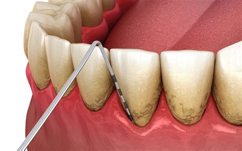 The Causes And Symptoms Of Gum Disease | Encinitas, CA