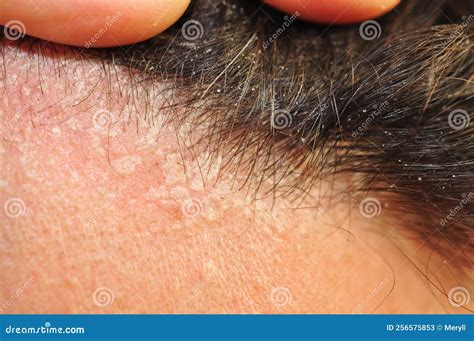 Seborrhea Seborrheic Dermatitis Stock Image - Image of hair, truble ...