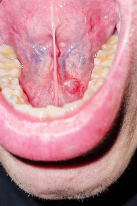 What Causes a Ranula (Cyst Under the Tongue) and How Is It Treated?