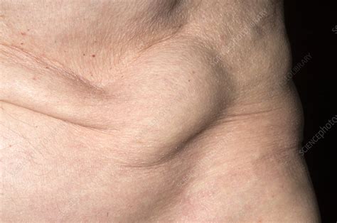 Abdominal hernia - Stock Image - M330/1554 - Science Photo Library