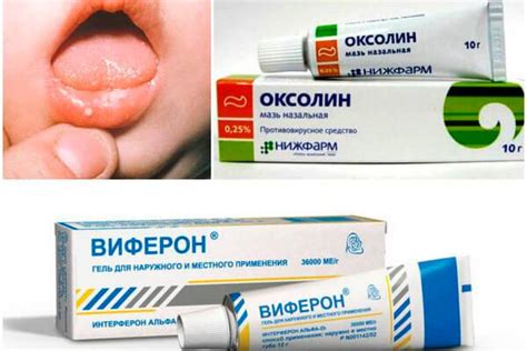 Как правильно выбрать мазь от стоматита