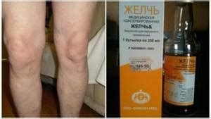 Медицинская желчь при артрозе коленного сустава: описание ...