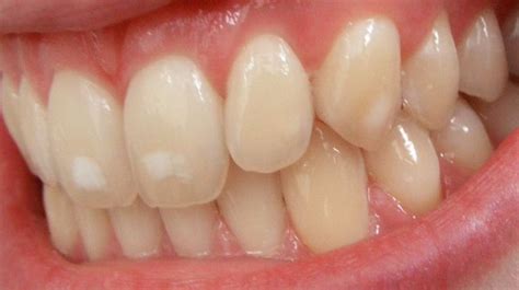 “MY TEETH HAVE WHITE SPOTS. WHAT ARE THEY AND WHAT CAN I DO?” If your ...