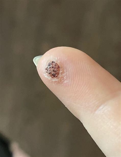 Dr froze wart two weeks ago, still have scab should i retreat or wait ...