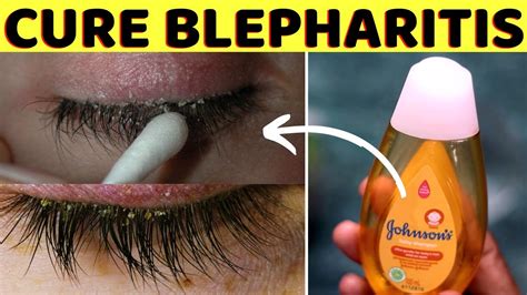 How to cure blepharitis naturally, fast and quickly at home using ...