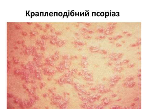 Папулосквамозні дерматози - online presentation