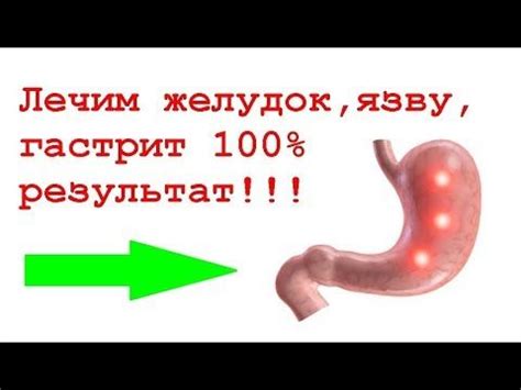 Лечим желудок, язву, гастрит 100% исцеление - YouTube | Товары для ...